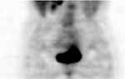 /ScottWilliamsMD2/NucMed/Tumor/CEA-scan/Cytogen%20cases/pet3.jpg (1205 bytes)