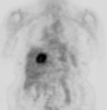 Pet Cholangiocarcinoma
