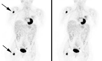 Pet Unsusp Bone Mets