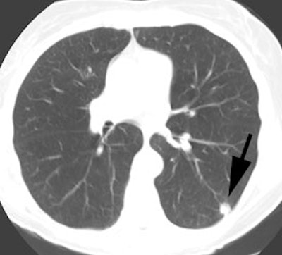 P Lung Ct