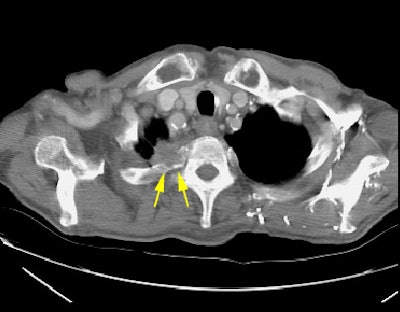 Pancoast Adeno W Rib Destruction