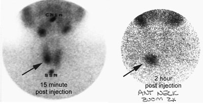 Parathyroid adenoma_MIBI.JPG (31481 bytes)