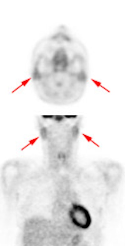 Parotid