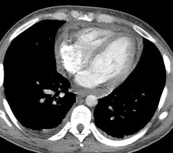 Pericarditis Ct