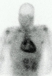 Pericarditis Ga 67