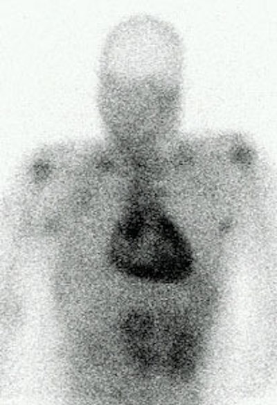 Pericarditis Ga 67