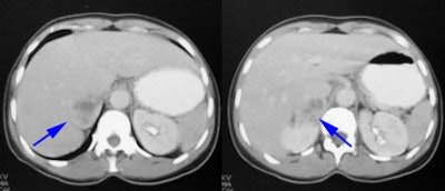 Pheo_CT.JPG (19041 bytes)