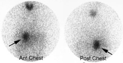 Pheo_MIBG.JPG (18840 bytes)