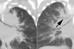 Pig Bronchus Ct