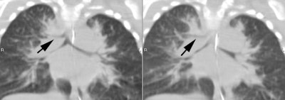Pig Bronchus Ct
