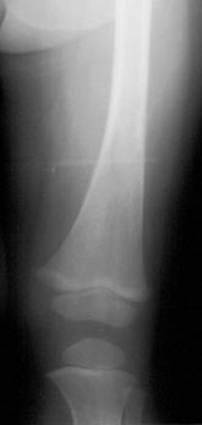 Plainfilm_Neuroblastoma2.jpg (7212 bytes)