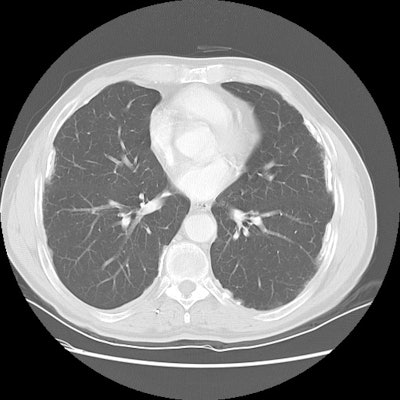 Pleural Plaques Ct