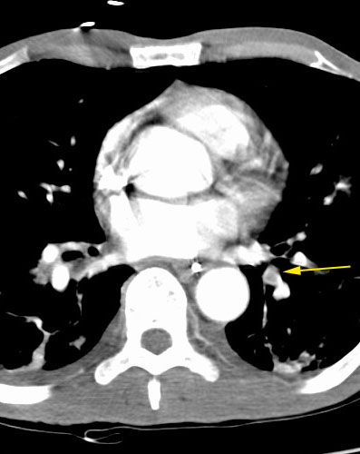 /ScottWilliamsMD2/CHEST/Vascular/PE/Images/Mucous_plug_mimicks_PE/plug_mimicks_pe.jpg (37245 bytes)