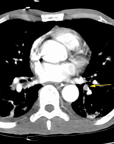 /ScottWilliamsMD2/CHEST/Vascular/PE/Images/Mucous_plug_mimicks_PE/plug_mimicks_pe.jpg (37245 bytes)