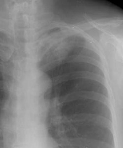 Ptx And Lesion Moves Cxr S