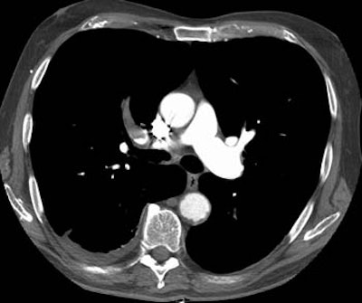 /ScottWilliamsMD2/CHEST/Vascular/PE/Images/Iliac%20DVT/rul.jpg (20528 bytes)