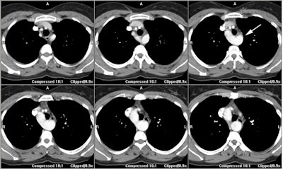 Rt Arch Aberrant Lt Axial