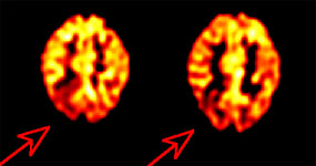 Rt_parietal_seizurefocus.JPG (15429 bytes)