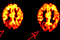 Rt_parietal_seizurefocus.JPG (15429 bytes)