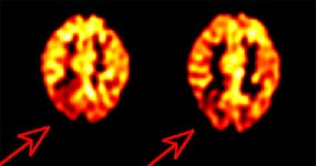 Rt_parietal_seizurefocus.JPG (15429 bytes)