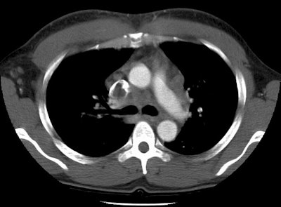 /ScottWilliamsMD2/CHEST/Vascular/PE/Images/Case2/svc.jpg (77820 bytes)