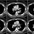 Saddle Embolus