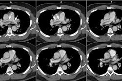 Saddle Embolus