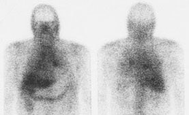 Sarcoid_Ga67.jpg (12299 bytes)