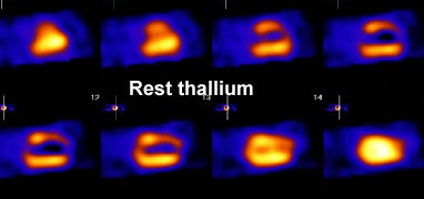 Scar Thallium