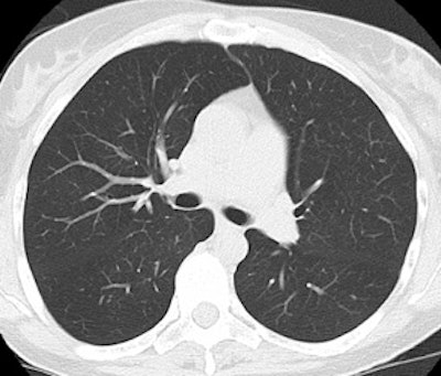 Screening Lung