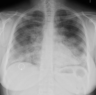 Sm_Pulmonary alveolar proteinosis.JPG (22403 bytes)