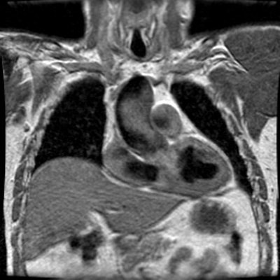 Small Coronal T1.JPG (58828 bytes)