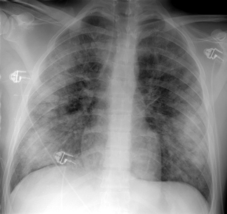 Small acute eosinophilic pneumonia.JPG (41435 bytes)