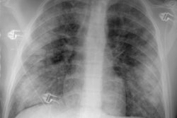 Small acute eosinophilic pneumonia.JPG (41435 bytes)