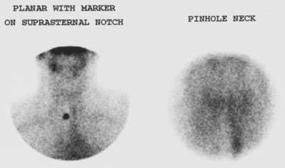 Subacute_thyroiditis.jpg (15231 bytes)