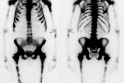 Superscan_prostate.JPG (18042 bytes)