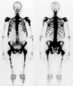 Superscan_prostate.JPG (18042 bytes)