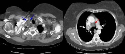 Supraclavicular Node S