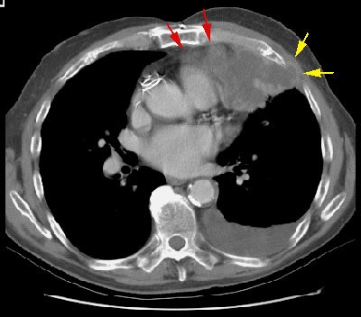 T3 Chest Wall Invasion