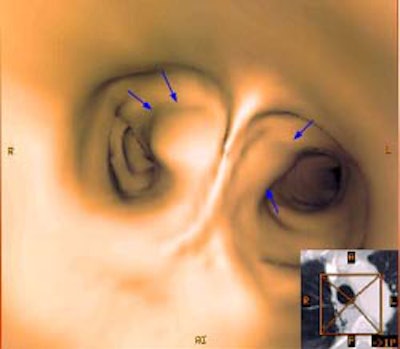 T4 Carina Vitual Bronch S