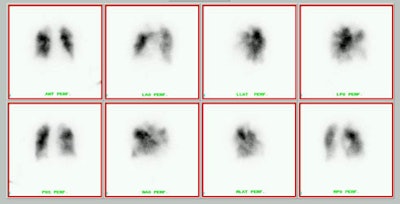 Tka Dvt High Prob Sm