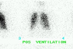 Tka Dvt Vent Sm