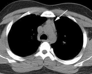 Thymus Ct