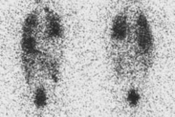 Thyroid_lungmets.jpg (28776 bytes)