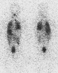 Thyroid_lungmets.jpg (28776 bytes)