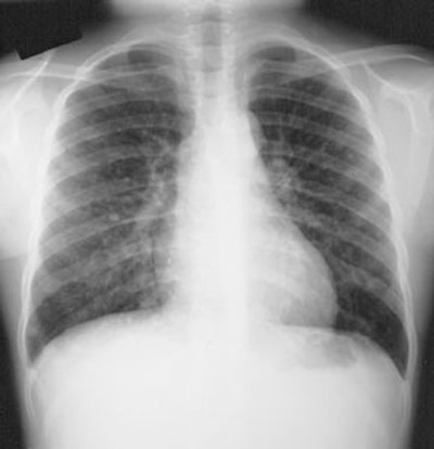 Thyroid_lungmets_CXR_sm.JPG (14250 bytes)
