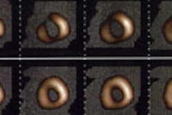 Tl201 Severe Ischemia Small