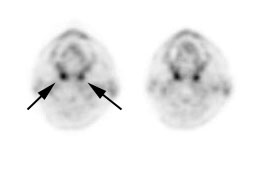 PET > PET tumor imaging > General | AuntMinnie