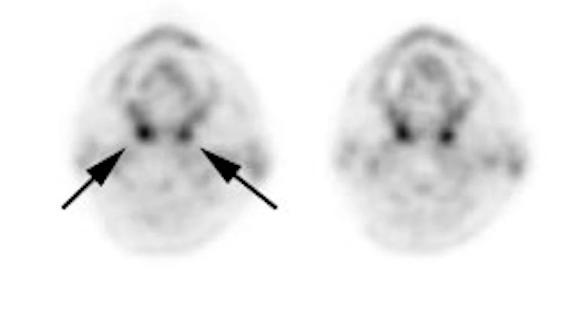 PET > PET tumor imaging > General | AuntMinnie PET > PET tumor imaging > General | AuntMinnie
