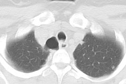 Tracheal_tic1.JPG (14692 bytes)